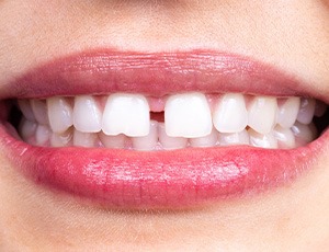 Closeup of someone’s smile with a diastema