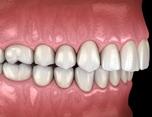 Illustrated overbite with black background
