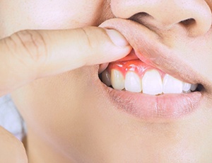 Woman lifting her lip to show red, swollen gums